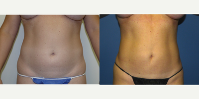 25-34 year old woman treated with Liposuction - Liposuction of the abdomen can be done in such a way as to accentuate the abdominal muscles. Reducing the fat at the outer edge of the rectus abdominis muscle is sometimes called six pack abs technique.