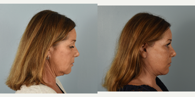 55-64 year old woman treated with CO2 Laser, Facelift, Eyelid Surgery, Neck Lift - This patient had the following procedures: mini facelift, neck lift, lower blepharoplasty, fractional CO2 laser. After photos are 2 months post op.