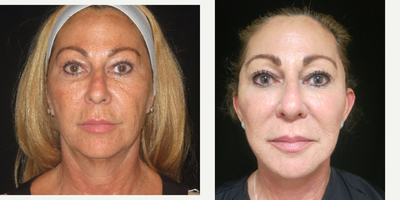 55-64 year old woman treated with Eyelid Surgery - Patient underwent full face and neck lift with fat grafting.