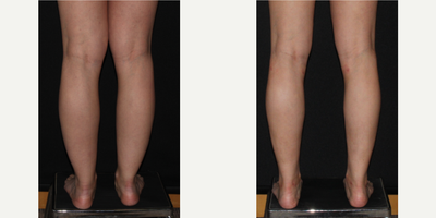 25-34 year old woman treated with Calf Reduction - Before and one year after liposuction to calves, ankles and medial knees.