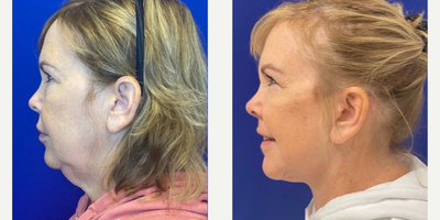 55-64 year old woman treated with Facelift, Neck Lift, Facial Fat Transfer, CO2 Laser - 59 years old 5 weeks after Facelift, Neck lift, and CO2 laser.
