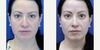 25-34 year old woman treated with Eyelid Surgery - Lower eyelid bags are the most common reason patients seek cosmetic improvement in this region. In-office procedure under local anesthesia offers quicker recovery without the immediate postoperative side effects of general anesthesia.