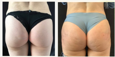 25-34 year old woman treated with Sculptra Aesthetic - Sculptra Butt-lift and hip dips correction by Dr. Deborah Marciano