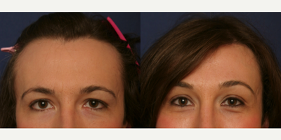 Transgender woman treated with Forehead Reduction - Transgender woman treated with Forehead Reductionas well as Brow Lift