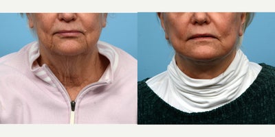 65-74 year old woman treated with Facelift, Lower Facelift, Neck Lift, SMAS Facelift, CO2 Laser, Laser Resurfacing - What an amazing transformation for this 69-year-old patient who underwent a lower face- and neck lift and CO2 laser skin resurfacing with Dr. Wise. After photos were taken 6 weeks post-op. She is thrilled with the outcome of her New Jersey facelift.