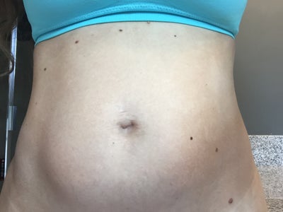 coolsculpting pe jersey realself nj