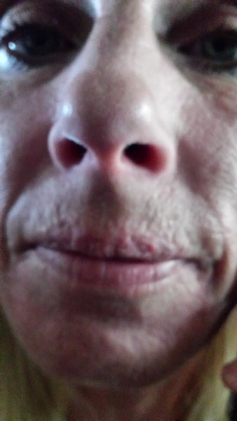 I have nerves exposed on upper lip causing pain and deformation. I have