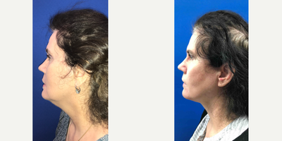55-64 year old woman treated with Chin Surgery - Neck and jawline sculpting with local anesthesia and a quick recovery.