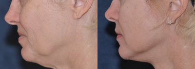 45-54 year old woman treated with Mini Lift - patient with early jowling and mid face descent