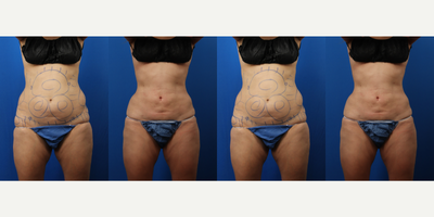 45-54 year old woman treated with Liposuction, Thermage, Exilis - 47 year old female with liposuction to mid section, that included Thermage on day of procedure. Followed by Exilis for additional skin tightening.