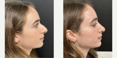 Woman treated with Rhinoplasty - Woman treated with Rhinoplasty