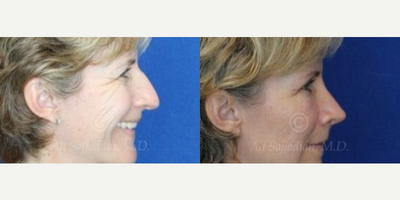 Woman treated with Eyelid Surgery - Woman treated with Eyelid Surgery