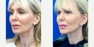65-74 year old woman treated with Neck Lift - This lady desires a tighter neck without a lot of downtime. Necklift lateral platysma suspension is performed under local anesthesia in the office setting. She enjoys her result shown here at only 2 months post-op.