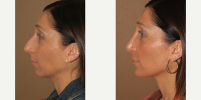 25-34 year old woman treated with Rhinoplasty - rhinoplasty and chin augmentation - intraoral approach