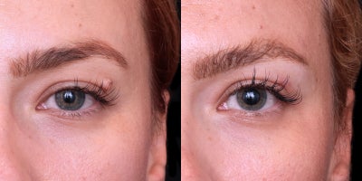 25-34 year old woman treated with Mole Removal - Eyelid mole removal via surgical excision. Precise technique for delicate eyelid area with excellent cosmetic results.