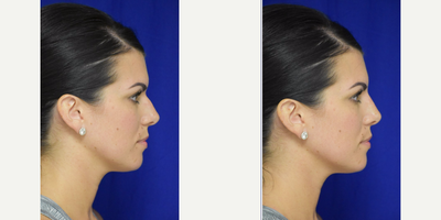 Liquid Rhinoplasty treatment for 35-44 year old New Orleans woman wanting a Non Surgical Nose Job - Immediate result from Injection of Juvederm Voluma to the nose by Dr. Sean Weiss in Metairie, Louisiana