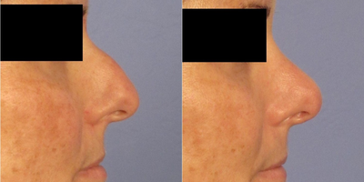 35-44 year old woman treated with Rhinoplasty - Open rhinoplasty: Dorsal hump reduction, tip refinement.