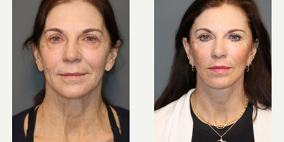 Enigmalift, deep plane vidalift, lovelift. - Deep plane face and neck lift with scarless lower eye bag removal, lip lift, fat transfer, laser resurfacing.