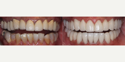 Woman treated with Dental Crown - Woman treated with 28 porcelain restorations (crowns and veneers) to replace 30 year old crowns and gummy smile which bothered her. Root canals were redone as well as gum lift. Patient is shown immediately post-op.