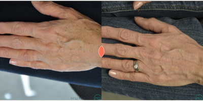 Woman treated with Skin Rejuvenation - Woman treated with Skin Rejuvenation