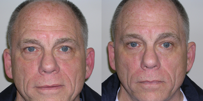 55-64 year old man treated with Eyelid Surgery - 62 year old male shown before and four months after a lower lid blepharoplasty (eyelid lift). Patient is height 62 and weight 185 pounds. Skin and fat removal was accomplished by a subciliary (lower lash line) incision.