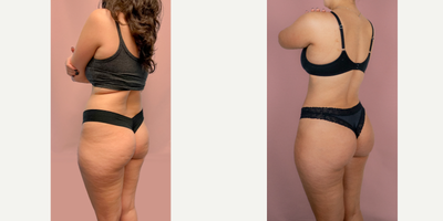 24 year old woman treated with Brazilian Butt Lift - This patient is shown 2 months after brazilian butt lift. 750mL of fat was transferred into each buttock/hip dip.