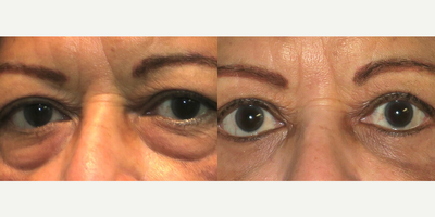 Woman treated with Eyelid Surgery - Woman treated with Eyelid Surgery