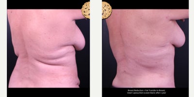 55-64 year old woman treated with Breast Reduction, Breast Fat Transfer, Vaser Liposuction - Breast Reduction + Fat Transfer to Breast, Vaser Liposuction (Lower Back) after 1 year