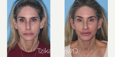 55-64 year old woman treated with Facelift - Deep Plane Facelift, Platysmaplasty, Lip lift, Lipografting & Upper Blepharoplasty