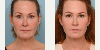 Woman treated with Facelift - This patient came to us bothered by her jowls and just wanted them lifted to redefine her jawline. She is a perfect example of how Dr. Balikians method of a deep plane facelift and deep neck lift can unveil your natural beauty without looking like a different person. She has such natural beauty to her face that combining an extended deep plane face and neck lift with conservative fat transfer and targeted laser resurfacing, unveiled those beautiful features without creating a done look.