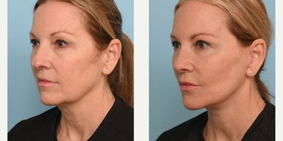 Woman treated with Facelift - Woman treated with Facelift