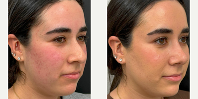 Woman treated with Rhinoplasty - Rhinoplasty