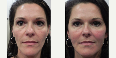 Liquid Facelift - Liquid Facelift