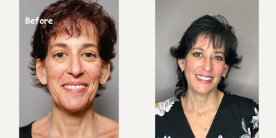 45-54 year old woman treated with Nonsurgical Facelift - Full face fat transfer using micronized fat and nanofat. Dr. Song developed and teaches the SCEFI technique which gives a long lasting, natural look without lumps and overfilling.