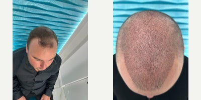 25-34 year old man treated with DHI Hair Transplant - This case presents the condition of the scalp 1 month after a DHI (Direct Hair Implantation) hair transplant performed at FullFace Clinic in a male patient aged 2534.At this stage, the transplanted area is healing properly, and early post-operative changes such as temporary shedding (shock loss) are visible and expected. The scalp shows good recovery with no signs of infection, excessive inflammation, or scarring. The donor area demonstrates even extraction and healthy healing.The procedure was planned with a focus on a natural hairline design, appropriate density, and long-term aesthetic balance. The DHI technique was used to allow precise placement of grafts with full control over angle, direction, and depth, which is essential for achieving a natural appearance once hair growth is complete.At one month post-op, visible regrowth is minimal, as the transplanted follicles are transitioning into the resting phase before entering active growth. Noticeable improvement is expected to begin around months 34, with progressive thickening and density development up to 12 months after the procedure.This stage represents an important foundation for the final result, which will continue to evolve over the coming months with proper follow-up and post-operative care.