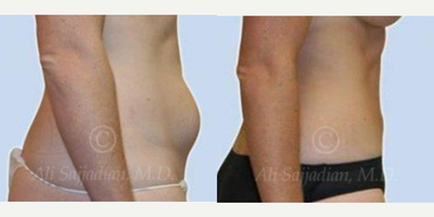 Woman treated with Mini Tummy Tuck - Mini Tummy Tuck