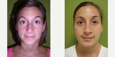 18-24 year old woman treated with Rhinoplasty - This patient underwent a Rhinoplasty