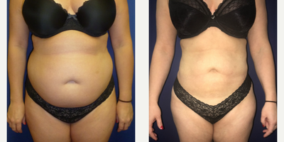 25-34 year old woman treated with Tumescent Liposuction - A woman in her 20s is shown 3 months after liposuction was performed on her abdomen.