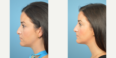 25-34 year old woman treated with Nonsurgical Nose Job - This patient was looking to address the hump on the bridge of her nose non surgically. A non surgical nose job was performed using the filler Restylane Lyft with excellent results.