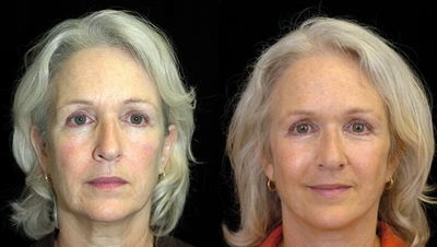 QuickLift - This patient received a QuickLift.