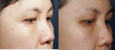 GentleLase - Before and after treatment of brown spot/lentigo with the long pulsed alexandrite - GentleLase -in an Asian patient.