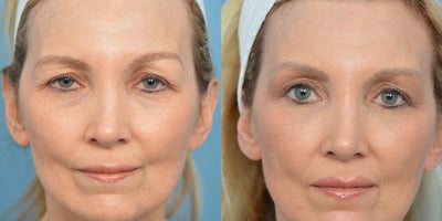 45-54 year old woman treated with Brow Lift - This patient was concerned with the signs of aging along her eyes and brows. A brow lift was performed to address her concerns.