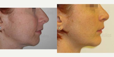 35-44 year old woman treated with Facial, Genioplasty - .