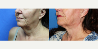 Woman treated with PrecisionTx - Liposuction - Neck / Precision TX Face & Neck