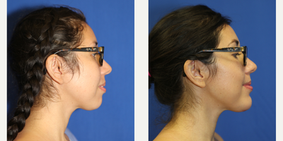 25-34 year old woman treated with Chin Implant - This patient in her mid-twenties was unhappy with the size of her chin. She had what we call a weak or receding chin. A chin implant was used to balance her facial features and improve her profile. The patient is happy with her new chin.