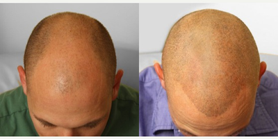 35-44 year old man treated with Hair Loss Treatment Scalp MicroPigmentation SMP - Scalp MicroPigmentation SMP