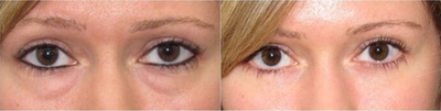 Woman treated with Eyelid Surgery - She underwent transconjunctival blepharoplasty