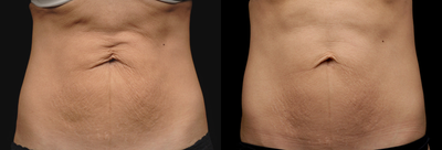 Body contouring - Patient wanted to reduce wrinkles around bellybutton.
