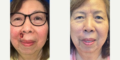 65-74 year old woman treated with Facial Reconstructive Surgery - Upper Lip Reconstruction with a Rhomboid Flap Following Mohs Surgery for Upper Lip Cancer 6 months post op
