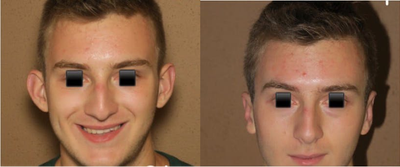Man treated with Ear Surgery - Man treated with Ear Surgery